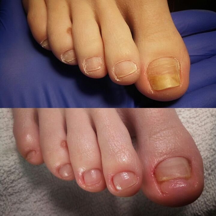 Antes y después de aplicar la crema Exodermin de Yesenia