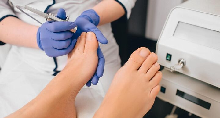 tratamiento profesional de hongos en las uñas de los pies