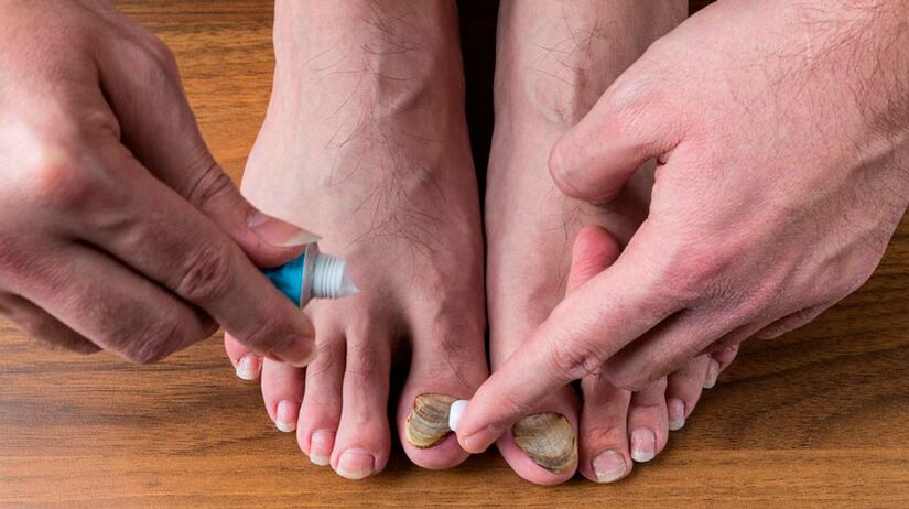 Aplicar una crema antimicótica en las uñas de los pies para tratar la onicomicosis