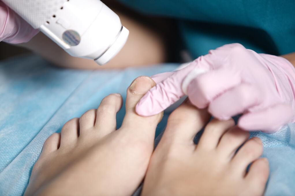 Pedicura médica en un podólogo para onicomicosis