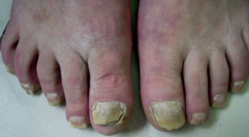 hongos en las uñas de los pies descuidados