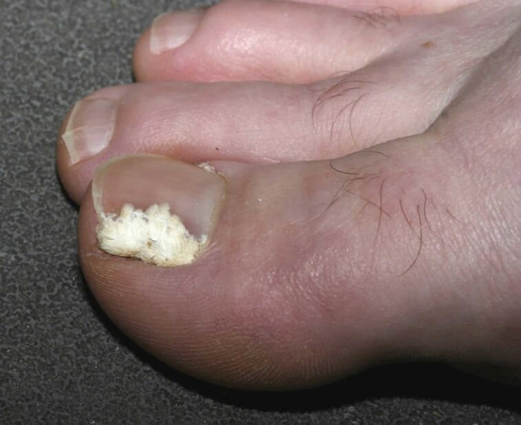 hongos superficiales en las uñas de los pies