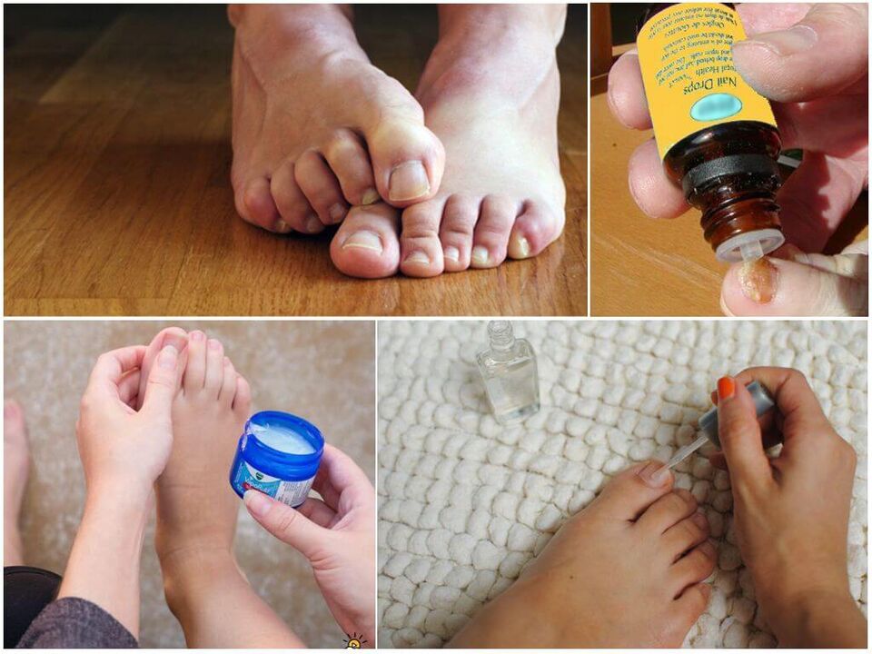 Tratamiento de hongos en las uñas de los pies con soluciones, ungüentos y barnices antimicóticos. 