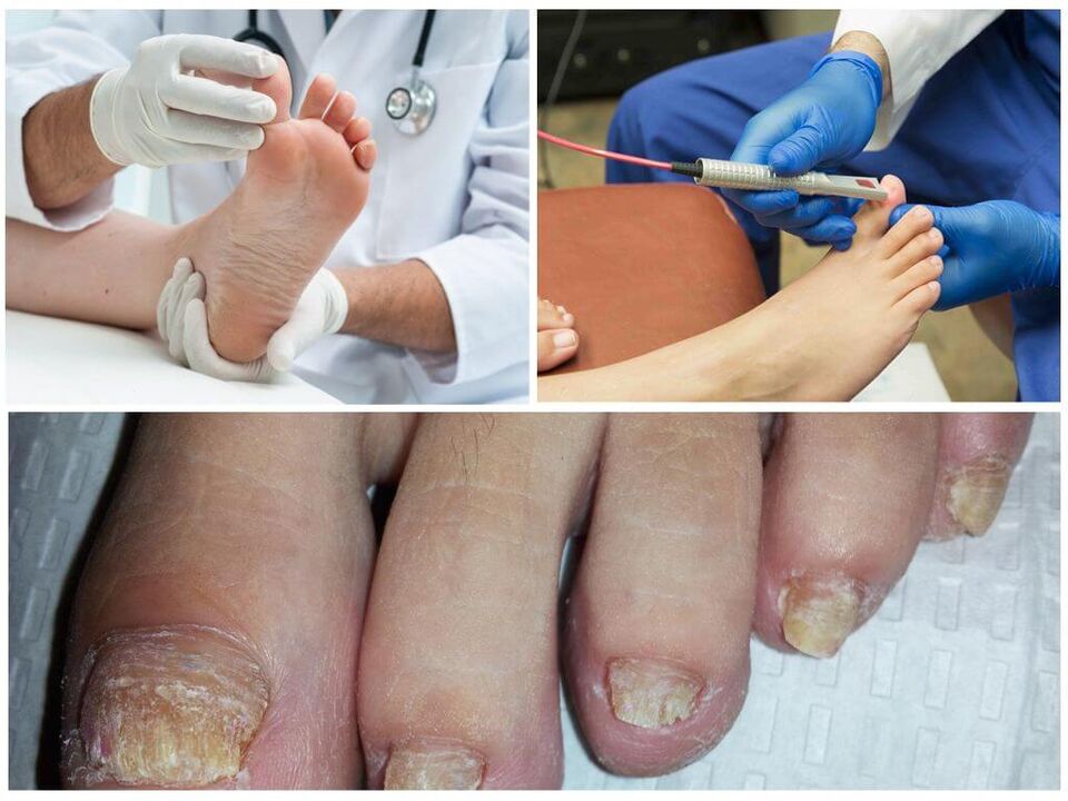 Un médico diagnostica y trata las uñas de los pies afectadas por una infección por hongos. 