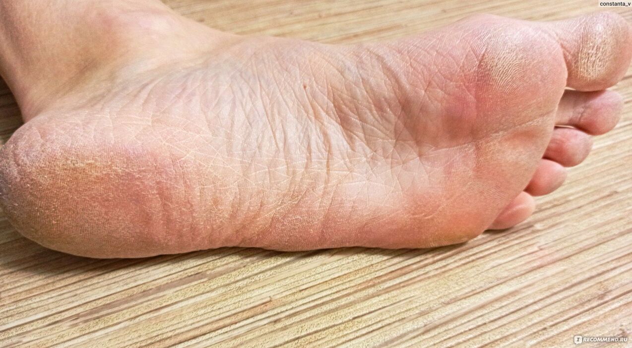hongo en pie humano